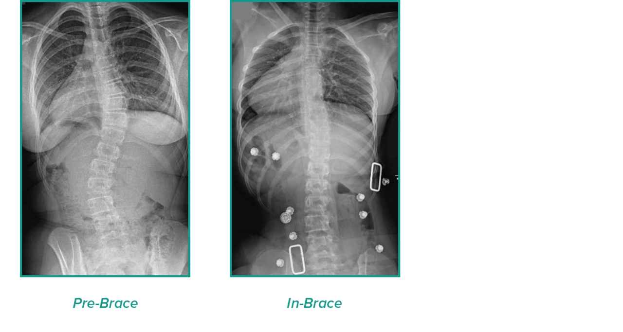 Case Studies CMP Brace 2 - CMP Brace