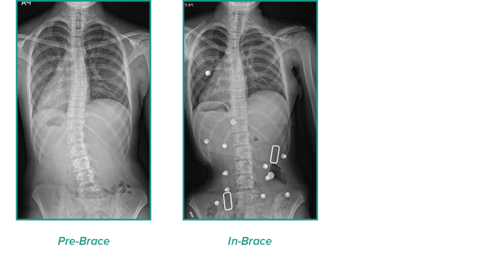 Case Studies CMP Brace 2 - CMP Brace